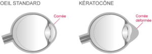 keratocone